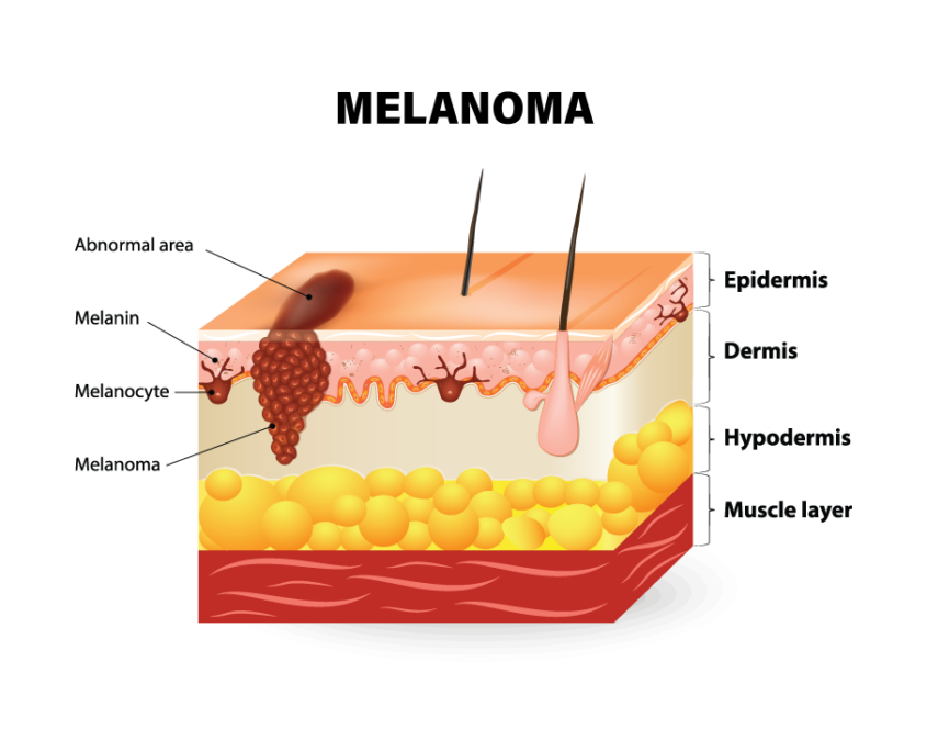 Sun Exposure and Skin Cancer: What You Need to Know— by Camrey Tuttle ...