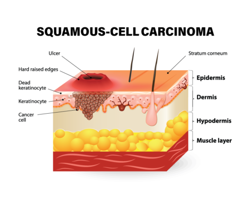 Sun Exposure and Skin Cancer: What You Need to Know— by Camrey Tuttle ...