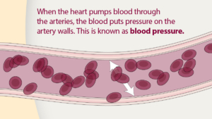 When the heart pumps blood through the arteries, the blood puts pressure on the artery walls. This is called blood pressure.